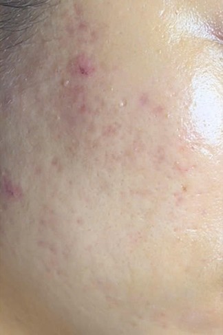 Sau liệu trình — Trước và sau Acne Peel