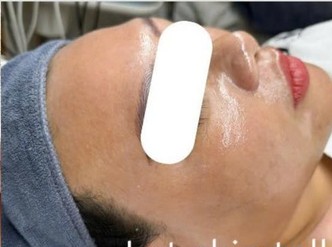 Sau liệu trình — Sau 2 ngày Bihaku Peel